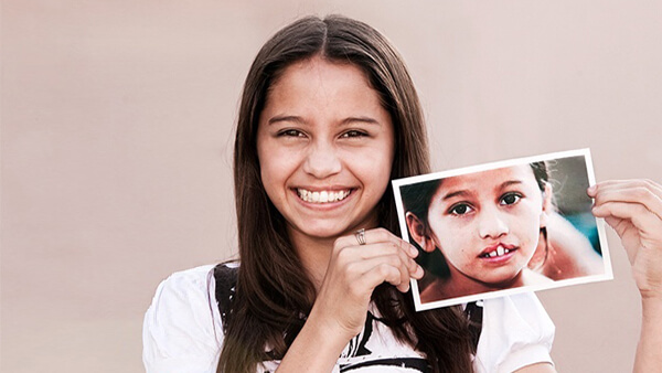 Cleft Lip & Palate